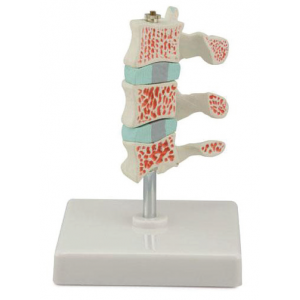 Advanced Osteoporosis Model